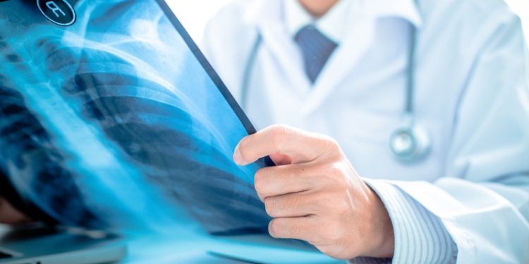 Akciğer Embolisi İyileşir Mi ?