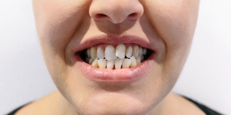 Diş Sağlığınızı Süt İçerek Koruyun