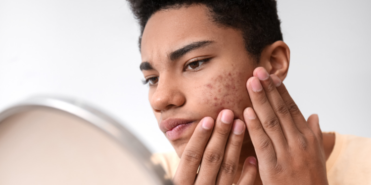 Geçmeyen Sivilceleriniz Varsa, Köpek Memesi Hastası Olabilirsiniz