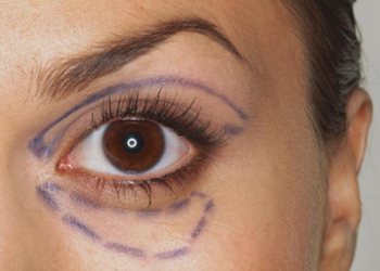 Göz Estetiği Ameliyatlarından Merdiven Altına Dikkat !