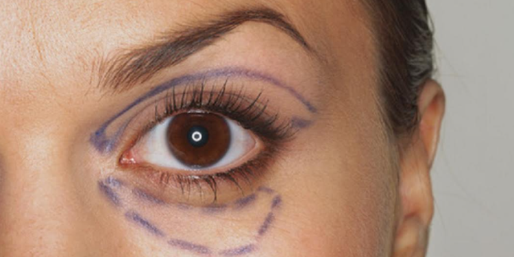 Göz Estetiği Ameliyatlarından Merdiven Altına Dikkat !