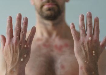 Maymun Çiçeği Aşısı Var Mı ?