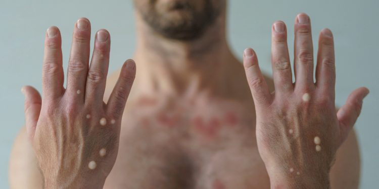 Maymun Çiçeği Pandemi Yapacak Mı ?