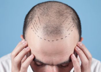 Saç Ekimi Nasıl Yapılır