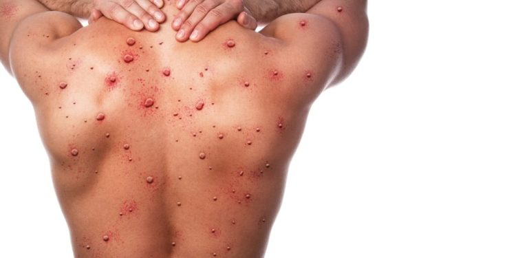 Türk Bilim İnsanları Maymun Çiçeği için PCR Tanı Kiti geliştirdi!