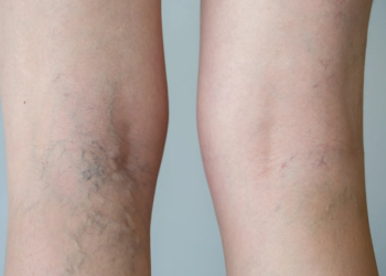 Yaz İçin Varis Hastalarına Öneriler