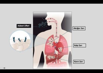 Mezotelyoma Hastalığı Nedir ?