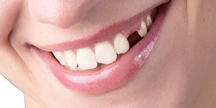 Eksik Diş Nelere Yol Açar ?